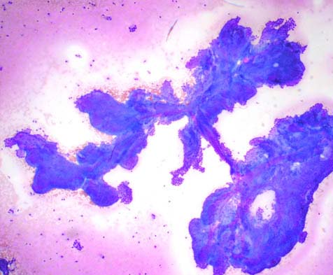 Punciones Biopsia o Aspirativas